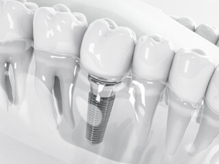 a 3D illustration of a dental implant