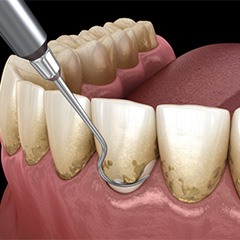 a digital illustration of scaling and root planing